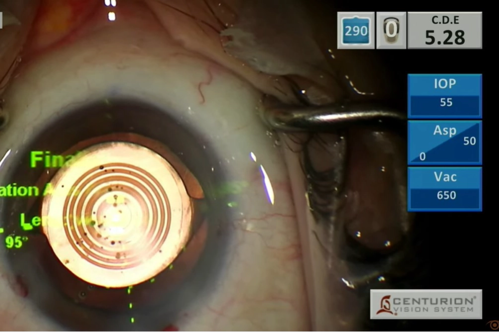 Canlı yayında göz ameliyatı yaptılar